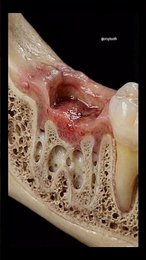 What Happens After Tooth Extraction? | Healing Process Day by Day 🦷