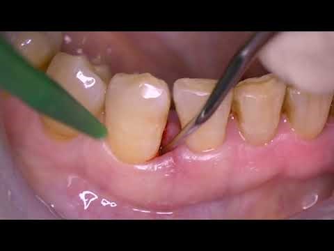 Prof. Aimetti’s approach for the treatment of intrabony defects using Straumann Emdogain® FL
