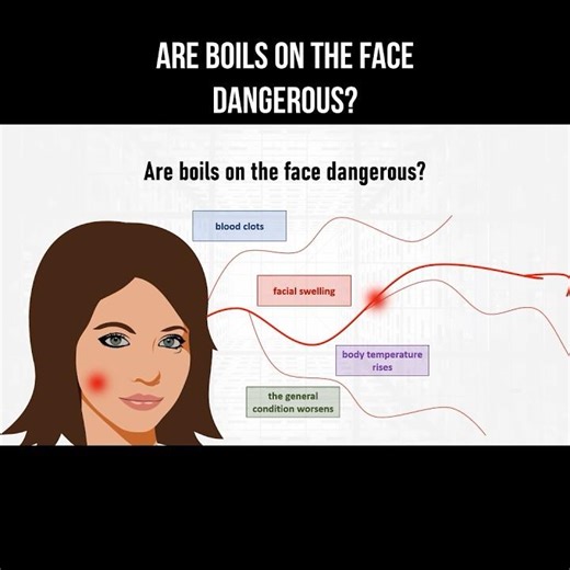 Are boils on the face dangerous? #boils #furuncle #foliculite #dermatology