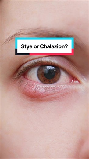 Stop ignoring that tiny red bump on your eyelid 👀 If your “stye” keeps coming back in the same spot it’s probably not a stye at all, it’s a chalazion, a blocked oil gland. Antibiotic drops won’t fix it because there’s no infection. What actually works? Consistent, sustained heat for 8–10 minutes to melt the blocked oil, followed by a gentle lid massage. If it’s firm, painless, or keeps returning, it’s time to book an exam. Treat the root cause, not just the symptom 👏 #eyecare #healthandwellnes