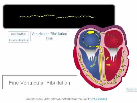ECG Rhythm Review: Coarse and Fine Ventricular Fibrillation