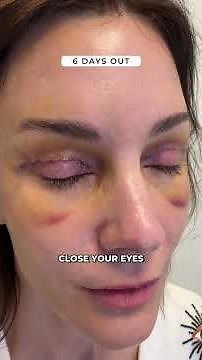 Endobrow and upper blepharoplasty