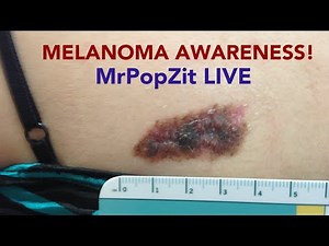 MELANOMA AWARENESS! Real life case discussions of different types of Melanomas.MrsPopZit appearance!