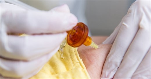 Carboxiterapia: o que é a técnica e quais as indicações