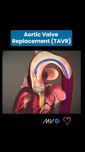 Cardiology Echocardio on Instagram: "🫀Transcatheter aortic valve replacement (TAVR) is a procedure to replace an aortic valve that is narrowed and doesn't open fully. The aortic valve is between the left lower heart chamber and the body's main artery. Narrowing of the aortic valve is called aortic valve stenosis. The valve problem blocks or slows blood flow from the heart to the body. ▶️ TAVR is minimally invasive, which means it uses smaller incisions than open-heart valve surgery. It may be a