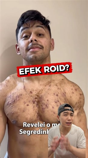 Side effects of using roids?! #bodybuilding #bodybuilder #performanceenhancement #bodybuilding #m...