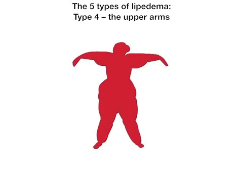 What is Lipedema?