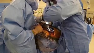 Insignia® Hip Stem through the Direct Anterior Approach (DART™)