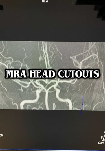 MRA Head Cutouts: A Step-by-Step Guide