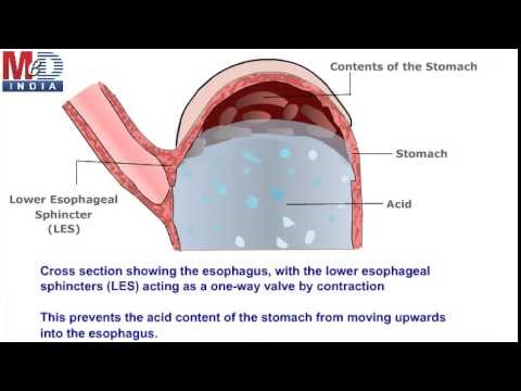 Health Animation - Reflux Esophagitis