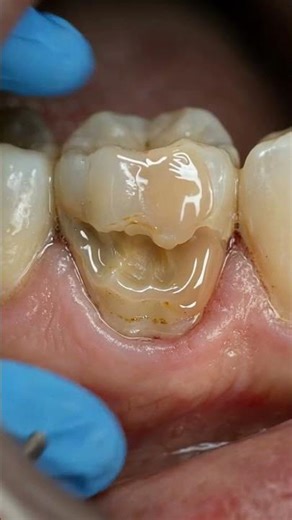Gumline Rot Reveal 🦷