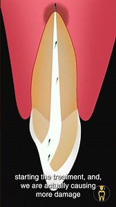Never give open dressing #dentist #endodontics #dentaltips