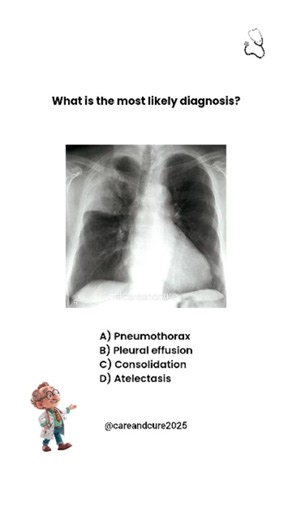 CareAndCure on Instagram: "Diagnose this CXR! Drop your guess below 👇 Follow @careandcure2025 for more #Medical and #Health related content. This content is for educational purpose only,not a medical advice. 📷 Credit: amboss_med ✨ Struggling with the transition to clinical practice? My guide covers using AI, managing stress, and thriving in your internship.Link in bio! #medicine #medstudent #medicalschool #plab #usmle #careandcure #radiology #pulmonology"