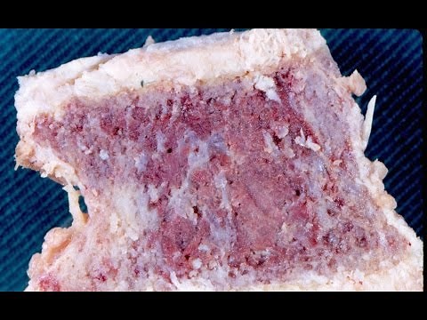 Paget's Disease of Bone - Pathology mini tutorial