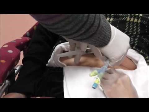 PEG・GB胃ろうバルーンチューブ交換4