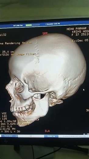 CT 3D Face #anatomy