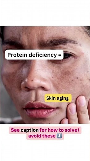 Signs of Protein Deficiency You Think Are Normal | Hair Loss, Brittle Nails & Skin Aging Explained