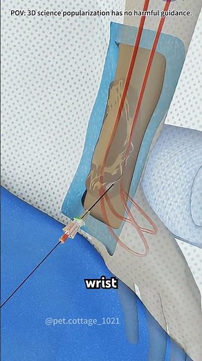 Prostate artery embolization (PAE) #drone #theflash #space