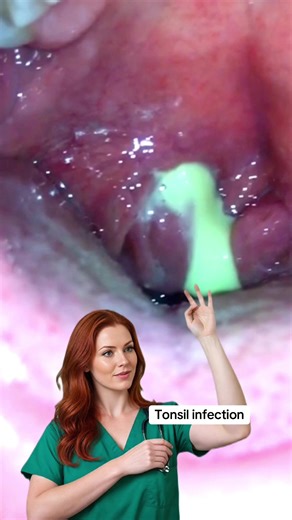 Understanding Tonsil Infection: Causes and Symptoms