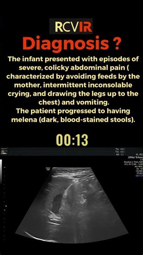 Infantile Intussusception: The "Target Sign" in Acute Abdomen Ultrasound