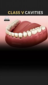 21K views · 218 reactions | G.V. BLACK’S CLASS 5 (V) CARIES. #dentalcaries #toothdecay #cavities #dental #tooth #3d #animation #decay | Dental Daily | Facebook