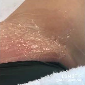 BRAZILIAN LASER HAIR REMOVAL TREATMENT IN ACTION!