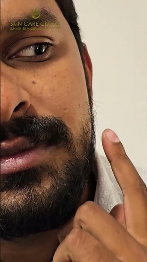 BEARD GFC/PRP: Treat your beard hair With Growth Factor Concentrate