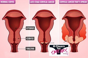 The 5 early signs you could have 'silent killer' cervical cancer - after millions skip smear tests