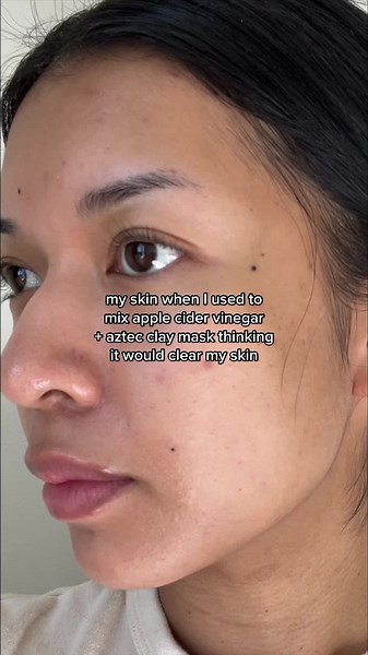 Aztec Clay Mask: Sensitivity & Skin Barrier Damage