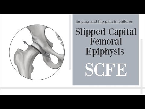 Slipped Capital Femoral Epiphysis (SCFE) (subtitled)
