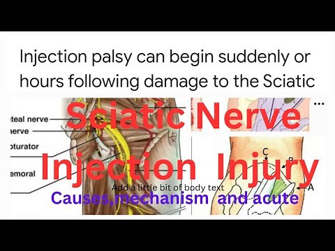 sciatic nerve injection injury/#sciatic nerve pain#Intramascular injection #nursing exam preparation