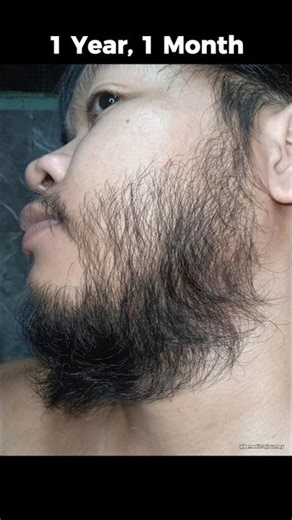 I Tried Minoxidil for 1 Year… Here’s What Happened 😳