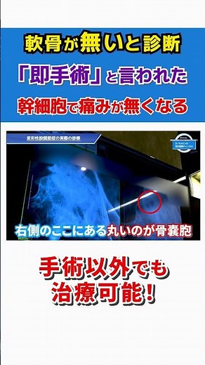 【変形性股関節症】軟骨が無いと診断され即手術宣告! 再生医療の注射で超回復！ #shorts