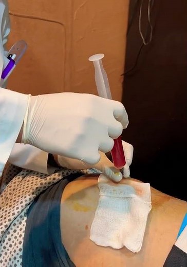 Drenaje de hematoma en muslo.