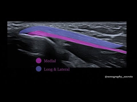 Triceps rupture ultrasound