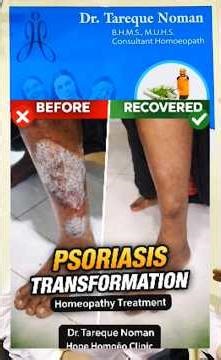 Foot Psoriasis Before After Result | Final Follow Up | Homeopathy Treatment