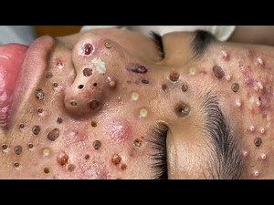 Remove Blackheads and Hidden Acne At Loan Nguyen Spa #36