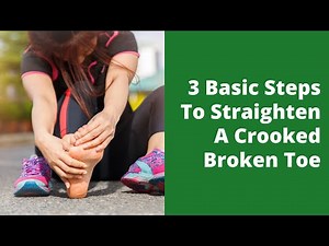 3 Basic Steps To Straighten A Crooked Broken Toe