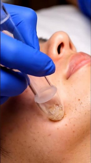 Professional Nose Cleaning ASMR | Vacuum Suction Treatment