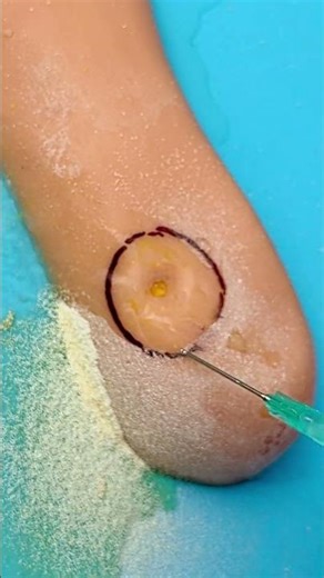 Satisfying Callus Removal You Have to See!