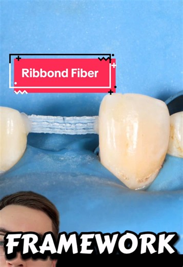 Ribbond fiber uses in dentistry: brief summary
