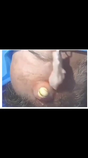 Pimple Popping 2021 on Instagram: "LINK IN BIO FOR FULL VIDEO.."