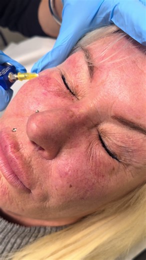 Transform Your Under-Eye Glow with Carboxy Therapy