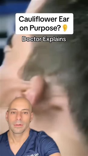 637 reactions · 17 shares | Cauliflower ear… on purpose? It is considered a badge of honor, but don’t do this on purpose! ✅Follow @drdavidabbasi for More Daily Medical Content & Health Tips! Schedule a consultation to see Dr. Abbasi as a patient in Delray Beach! Visit www.primeorthocenter.com #cauliflowerear #sports #medicine #mma #jiujitsu #nursing | David Abbasi, MD - Sports Medicine & Orthopedic Surgery | Facebook