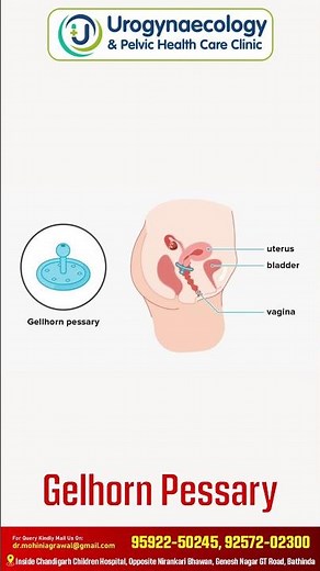 Learn All About Pessaries with Dr Mohini | Urogynecology | Urogynecology & Pelvic Health Care