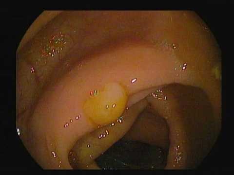 Beyond the cold snare polypectomy: Deciphering the white cord sign