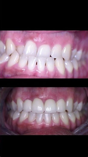 4 Veneers Fixed My Crossbite | Smile Correction Without Braces