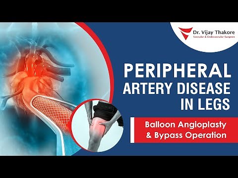 Peripheral Artery Disease in Legs | Balloon Angioplasty & Bypass Operation | Dr. Vijay Thakore #pad