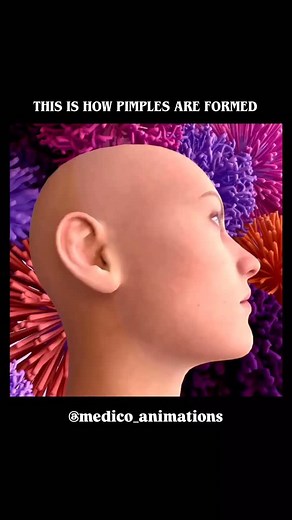 medical_animation | Formation of a Pimple (Pustule) Acne is created when hair follicles become blocked by dead skin cells mixed with sebum. The secretion of... | Instagram