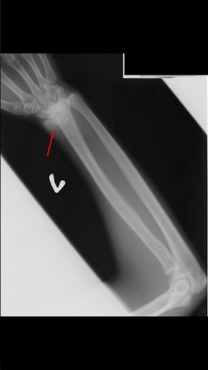 Salter-Harris fracture Type I #xraytech #virlshorts
